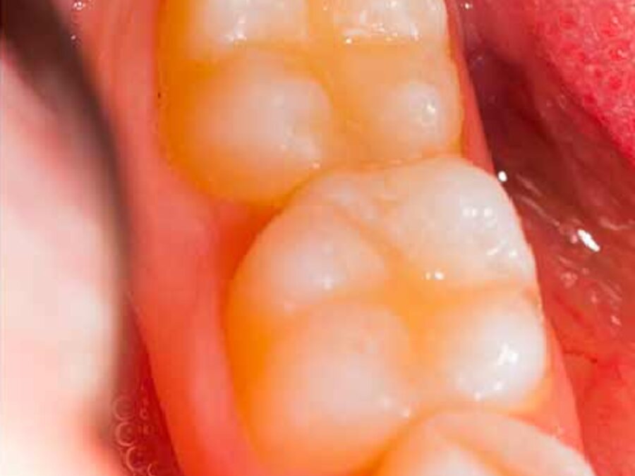 Cavities & fillings