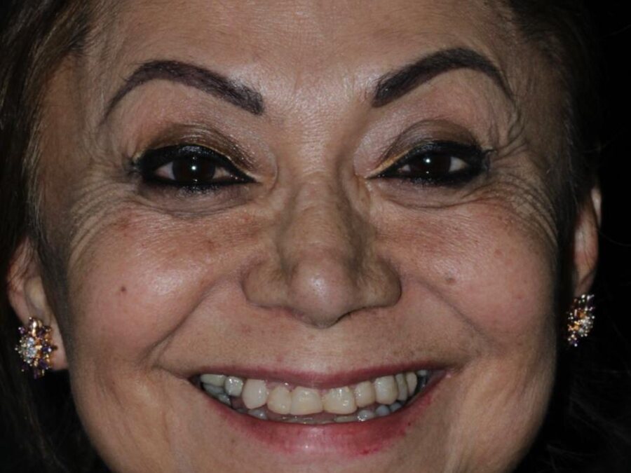 Carillas y diseño de sonrisa — Antes