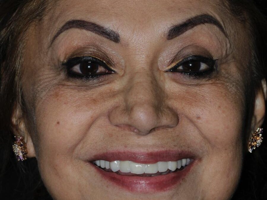 Veneers & smile design