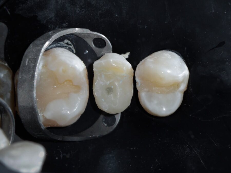 Root canals