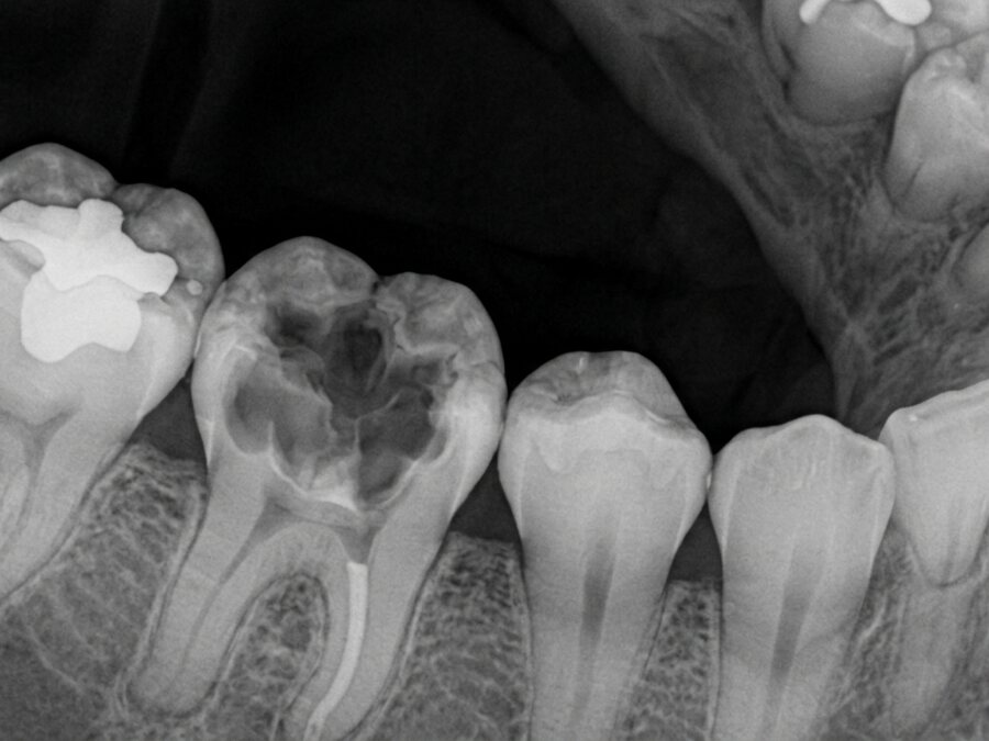 Endodoncia — Radiografía de control