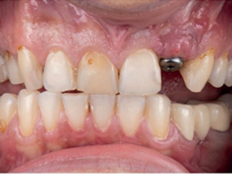 Dental implants — Before