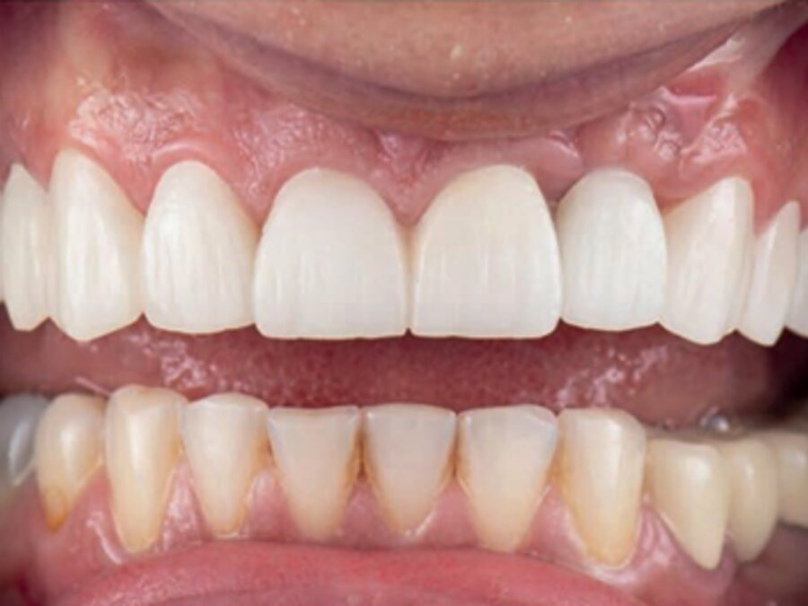 Dental implants