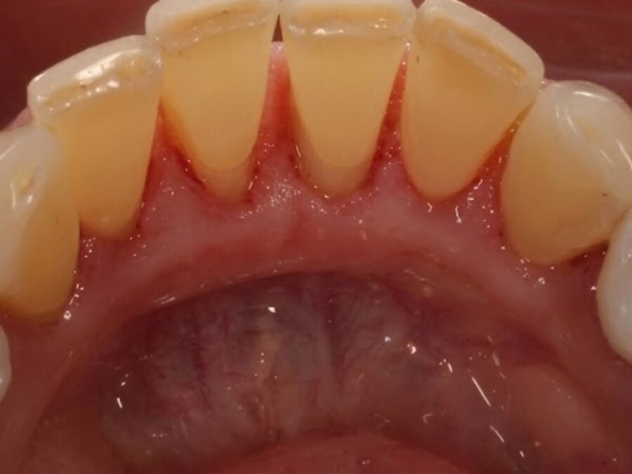 Dental cleaning