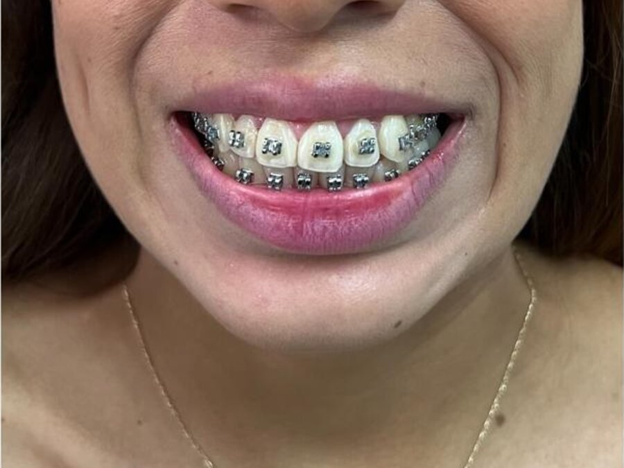 Orthodontics — Before